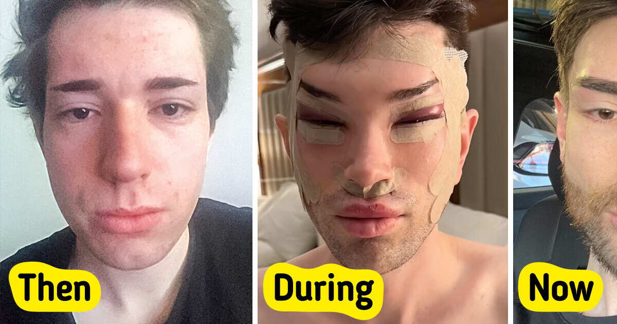 A Man Shows Off His Plastic Surgery Results, and It Shocks People A Man Shows Off His Plastic Surgery Results, and It Shocks People