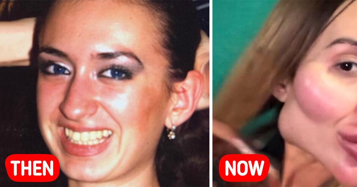 A Woman Gets Multiple Surgeries to Have “The World’s Biggest Cheeks,” Shares Photos A Woman Gets Multiple Surgeries to Have “The World’s Biggest Cheeks,” Shares Photos