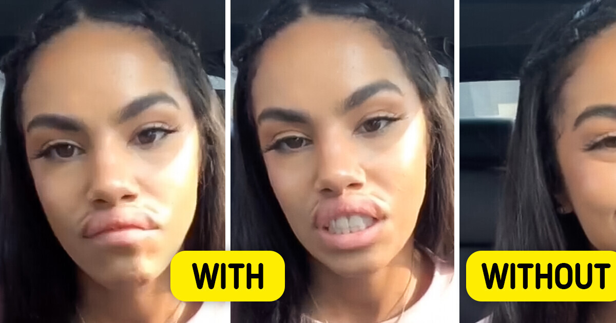 A Woman Pranks Her Partner With Lip Fillers and His Epic Response Steals the Spotlight A Woman Pranks Her Partner With Lip Fillers and His Epic Response Steals the Spotlight