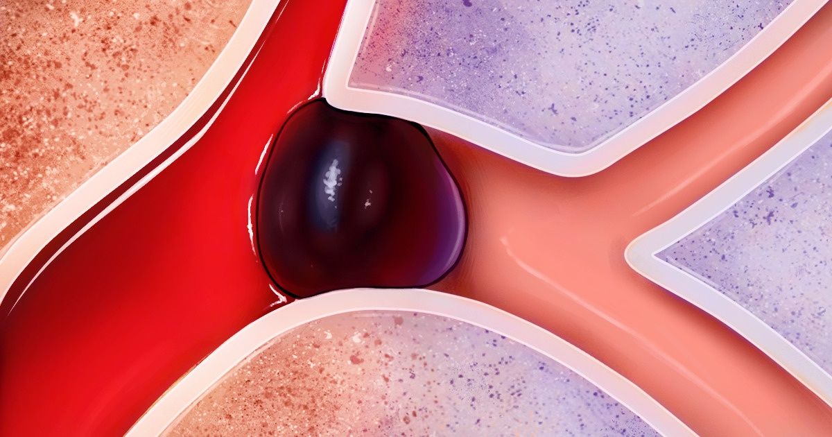 8 Effective Ways to Prevent Strokes, Get Rid of Headaches and Fatigue