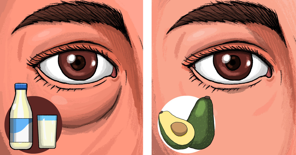 Dark Circles Under Eyes: Causes, Treatments & Preventive Tips – Vedix