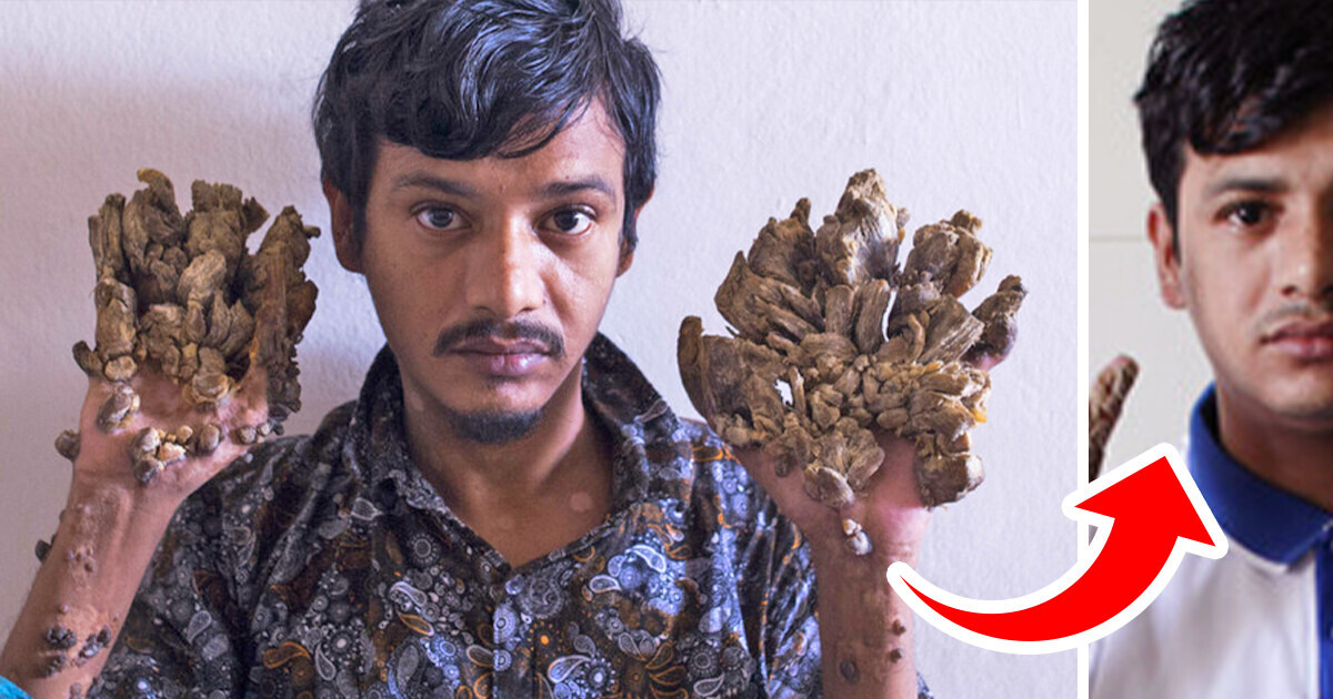 A “Tree Man” Undergoes 16 Surgeries to Be Able to Hold His Daughter Again