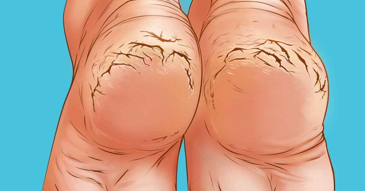 Why You May Get Cracked Heels And How To Fix Them Naturally