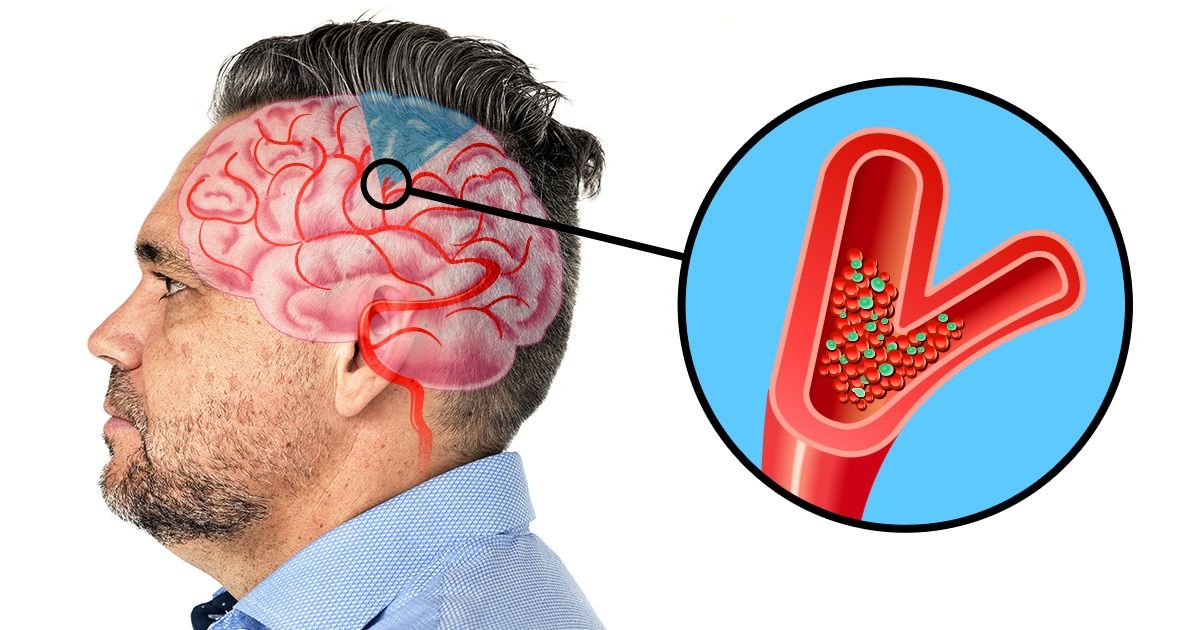 6 Warning Signs of a Stroke and It’s Really Important to Know Them 6 Warning Signs of a Stroke and It’s Really Important to Know Them