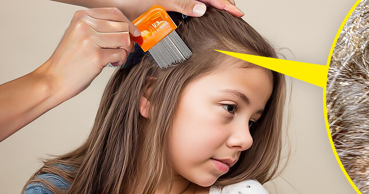 A Mom Refuses to Get Rid of Her Child’s Nits Because She’s Vegan A Mom Refuses to Get Rid of Her Child’s Nits Because She’s Vegan