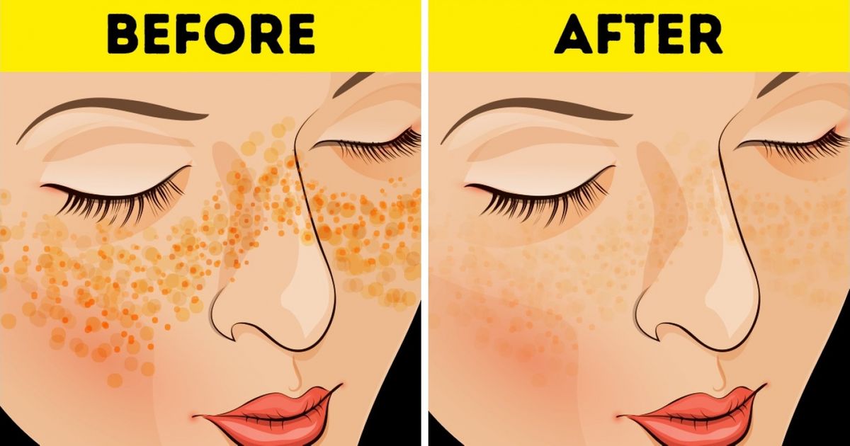 To get rid natural pimples overnight of ways How to