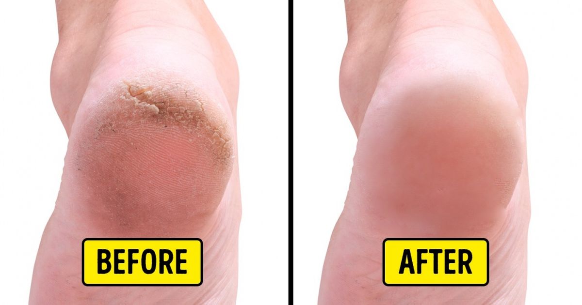 Home Remedies to Remove Cracked Heels 