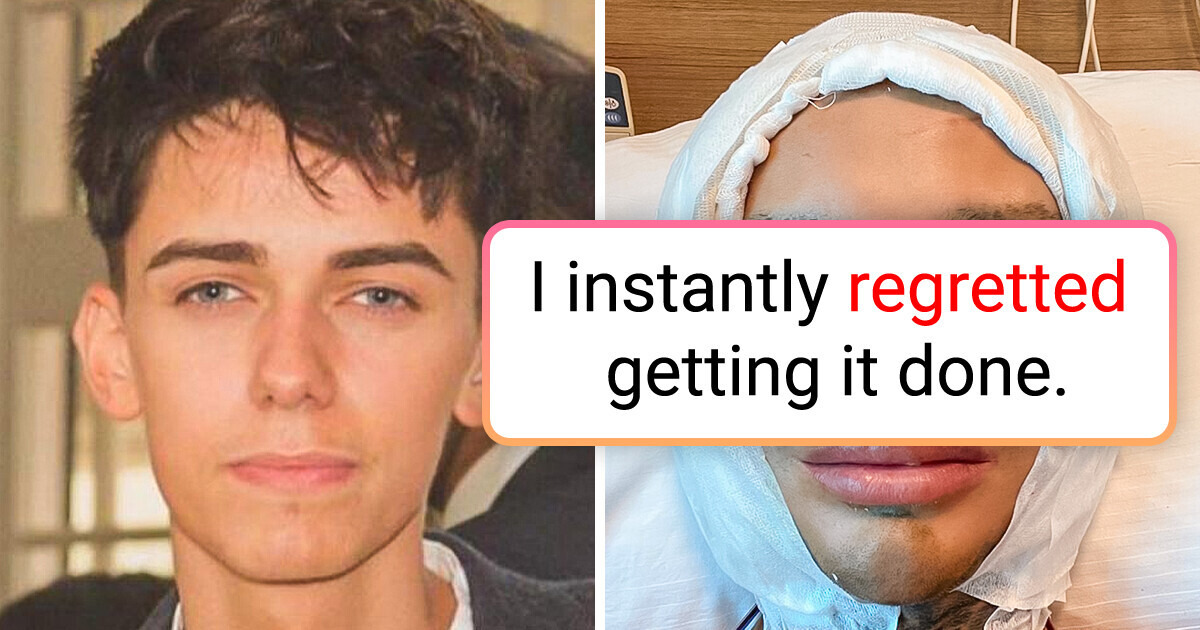 I Had Five Face Surgeries in One Day