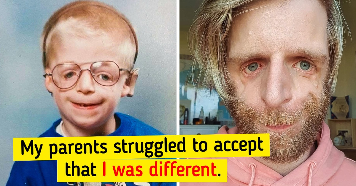 A Baby Was Abandoned Because of His Looks, and 37 Years Later He Became ...