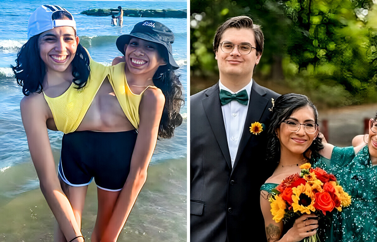 One of the Conjoined Twins Gets Married, People Say the Same Thing One of the Conjoined Twins Gets Married, People Say the Same Thing