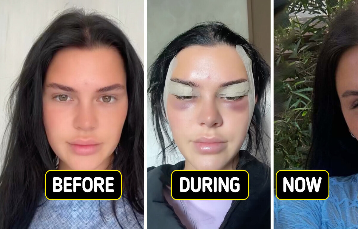 Young Woman Shares Her Fox Eye Surgery Journey—The Results Are Leaving People in Shock Young Woman Shares Her Fox Eye Surgery Journey—The Results Are Leaving People in Shock