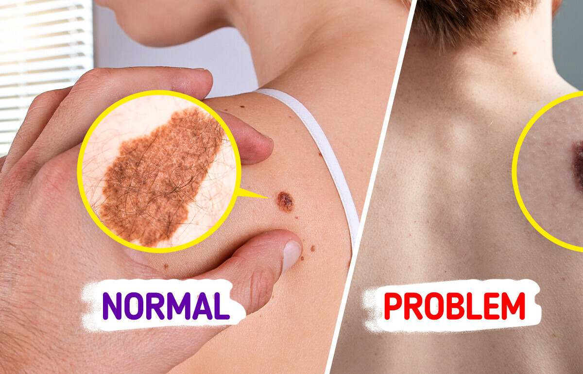 5 Warning Signs Your Moles Can Be Hiding a Skin Cancer 5 Warning Signs Your Moles Can Be Hiding a Skin Cancer