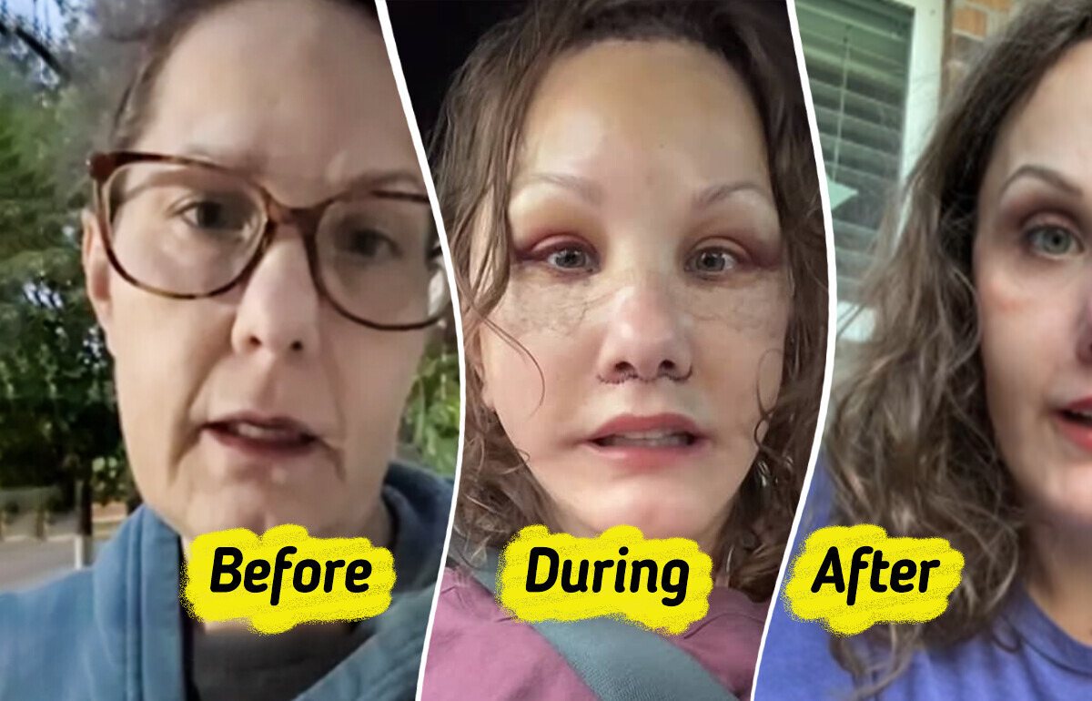 Woman, 50, Reveals Major Plastic Surgery Results That Make Her Look Decades Younger Woman, 50, Reveals Major Plastic Surgery Results That Make Her Look Decades Younger