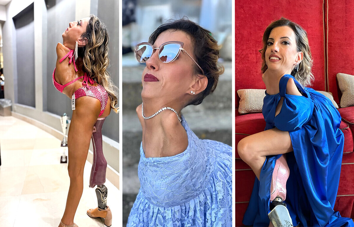 A Woman With Very Rare Condition Shatters Stereotypes and Becomes a Beacon of Hope for Many A Woman With Very Rare Condition Shatters Stereotypes and Becomes a Beacon of Hope for Many