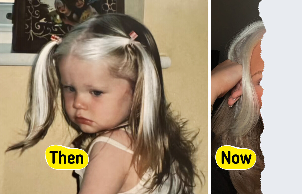 Woman, 24, Called a “Badger” Growing Up Shares How She Found Self-Love and Compassion While Living With a Rare Genetic Condition