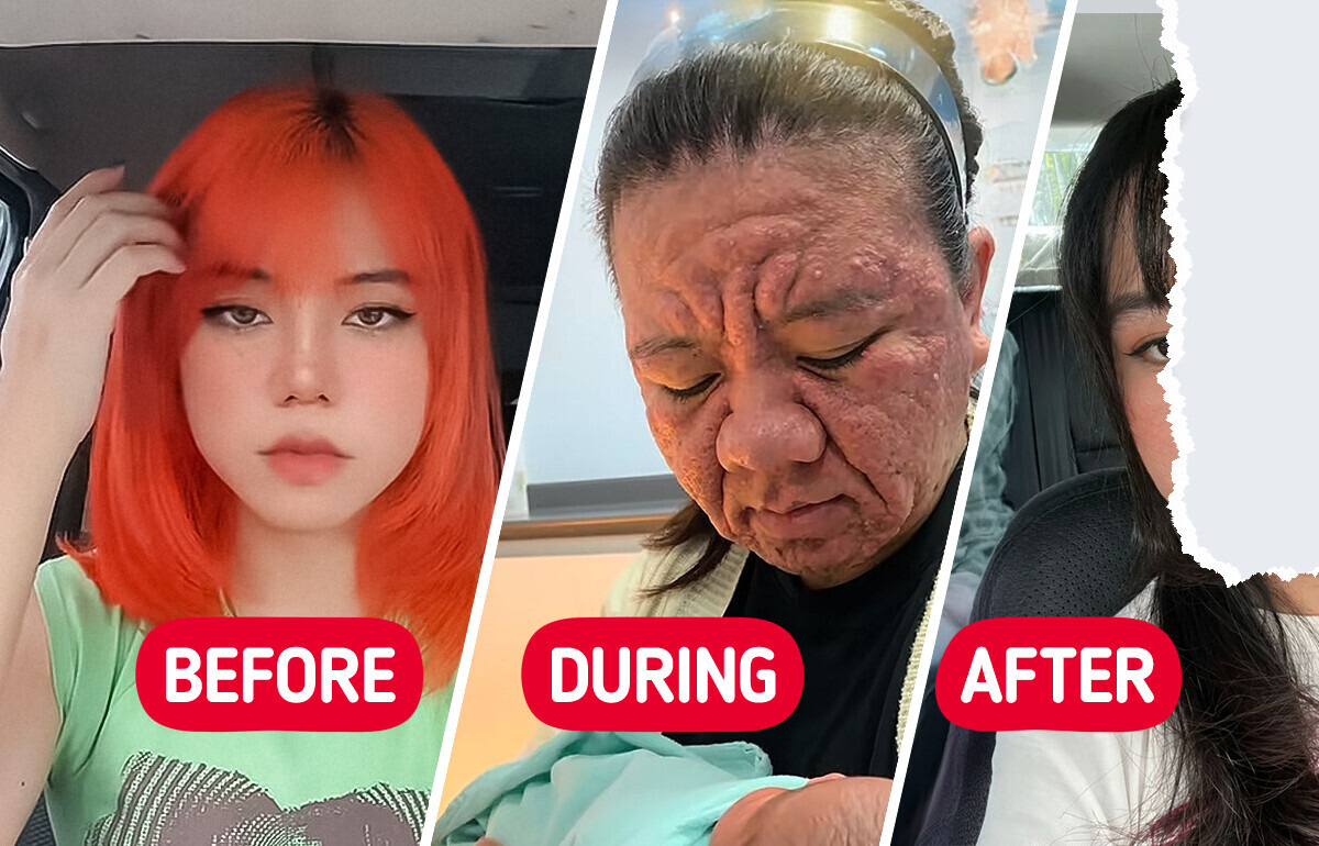“Are You Allergic to Your Baby?” Woman Shares How Pregnancy Changed Her Face That Proves the Power of Self-Love and Compassion