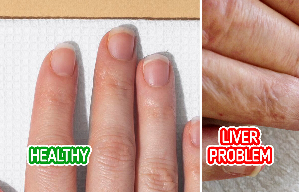 6 Surprising Signs Your Liver Can Be Struggling 6 Surprising Signs Your Liver Can Be Struggling