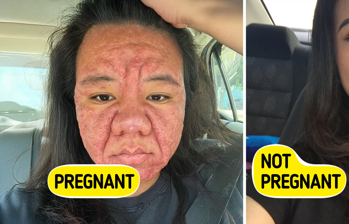 28-Year-Old Woman Reveals the Raw Truth of How Pregnancy Drastically Changes Her Face 28-Year-Old Woman Reveals the Raw Truth of How Pregnancy Drastically Changes Her Face