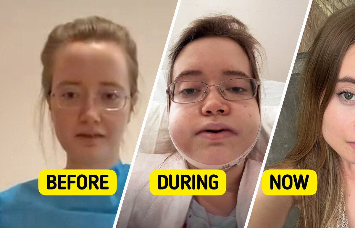 Singer Travels 24 Hours for Jaw Surgery, Shares Shocking Transformation Singer Travels 24 Hours for Jaw Surgery, Shares Shocking Transformation