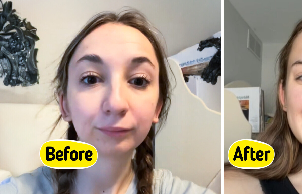 Young Woman’s Jaw Surgery Transformation Sparks Massive Reactions Young Woman’s Jaw Surgery Transformation Sparks Massive Reactions