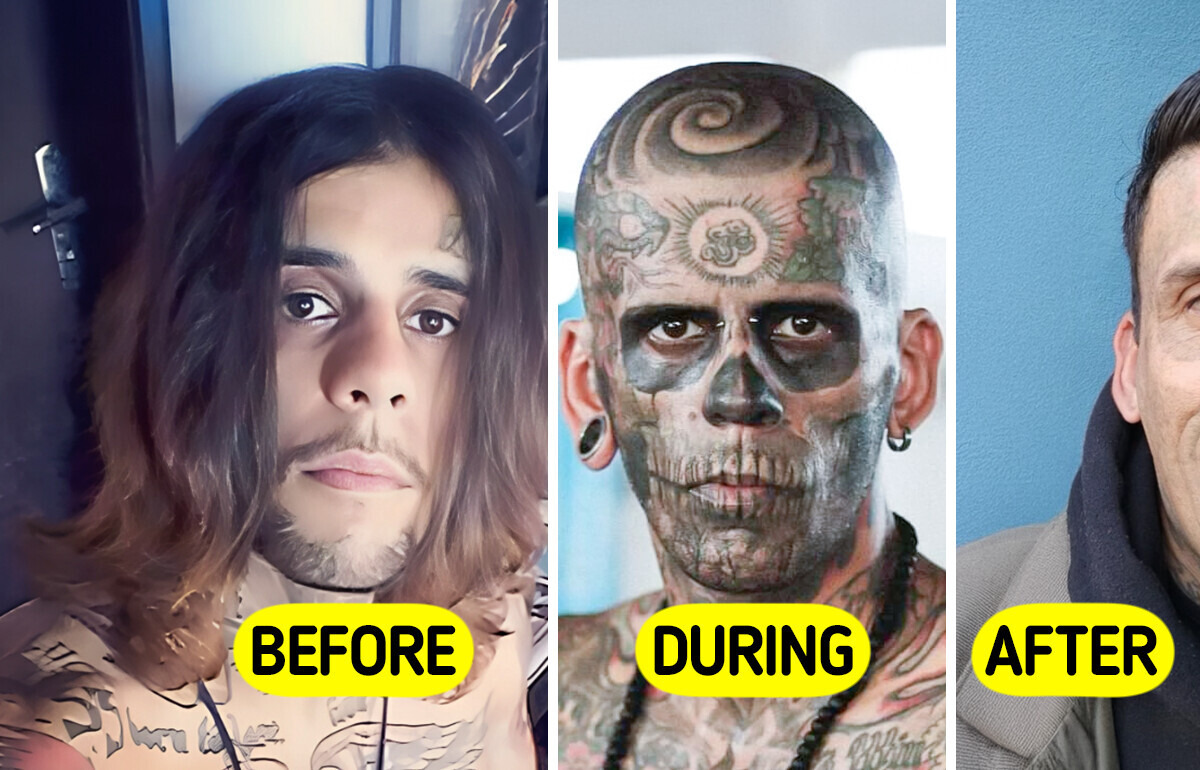 Man Who Was 95% Tattooed Shows Shocking Transformation After Laser Removal Surgery Man Who Was 95% Tattooed Shows Shocking Transformation After Laser Removal Surgery