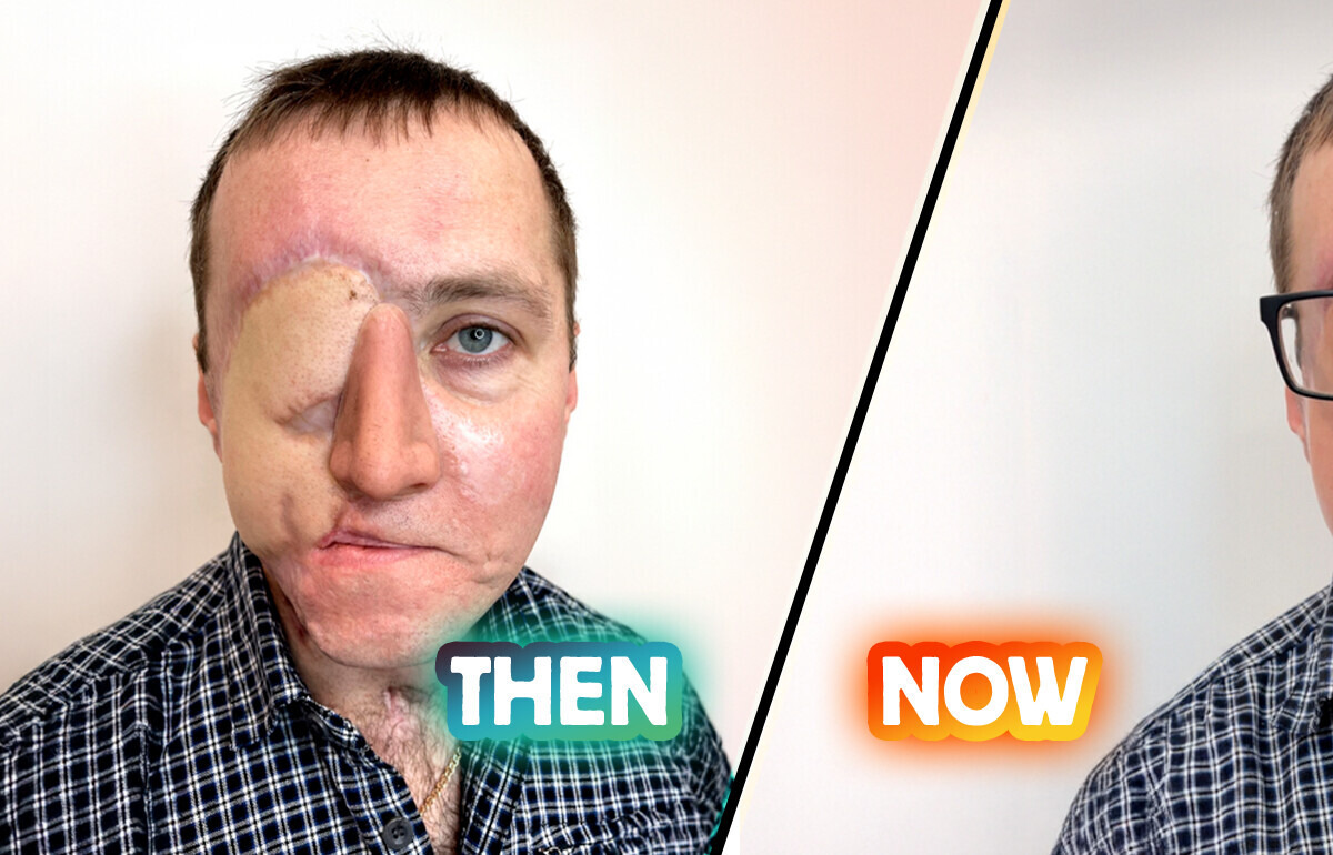 Tattoo Artist Turns Pain Into Art With Hyper-Realistic Eye Tattoo for Car Crash Survivor
