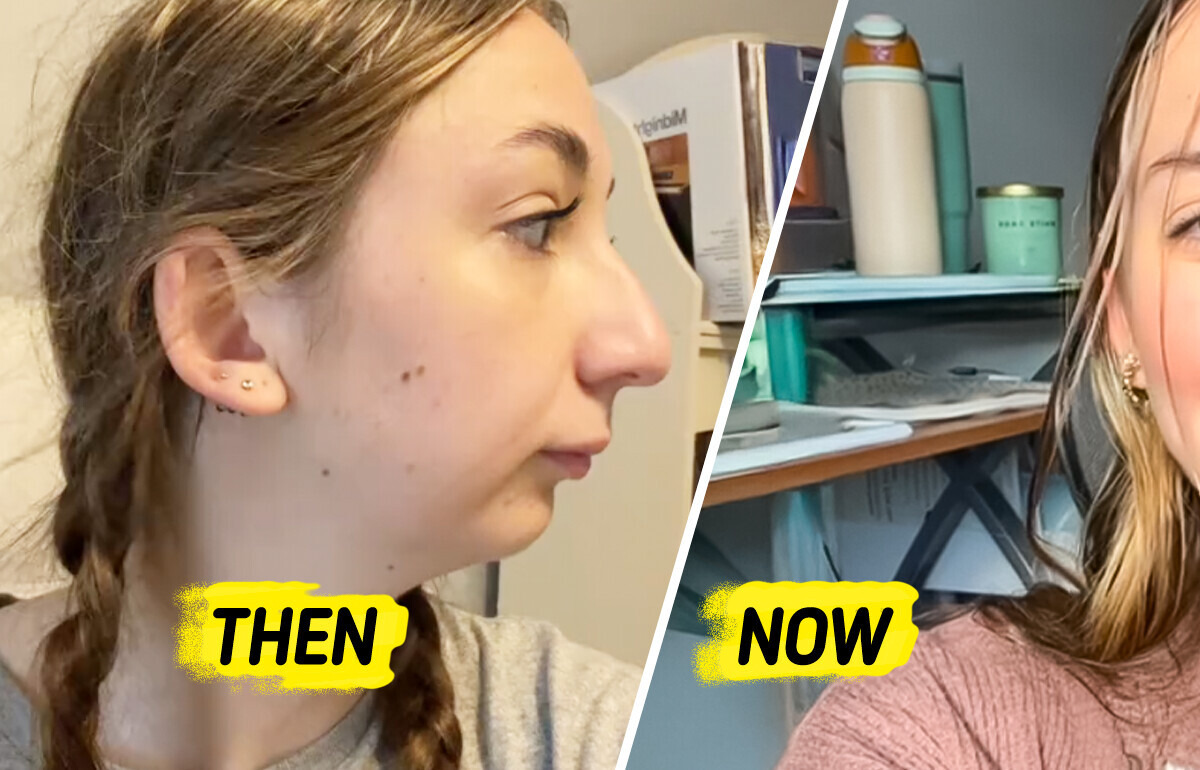 Young Woman Undergoes Complex Jaw Surgery and Stuns the Internet With the Change Young Woman Undergoes Complex Jaw Surgery and Stuns the Internet With the Change