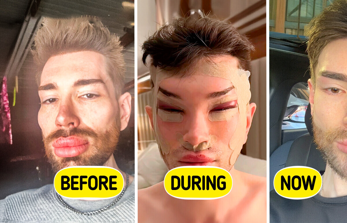 A Man’s Drastic Cat-Eye Surgery and Filler Removal Transformation Shocks Viewers