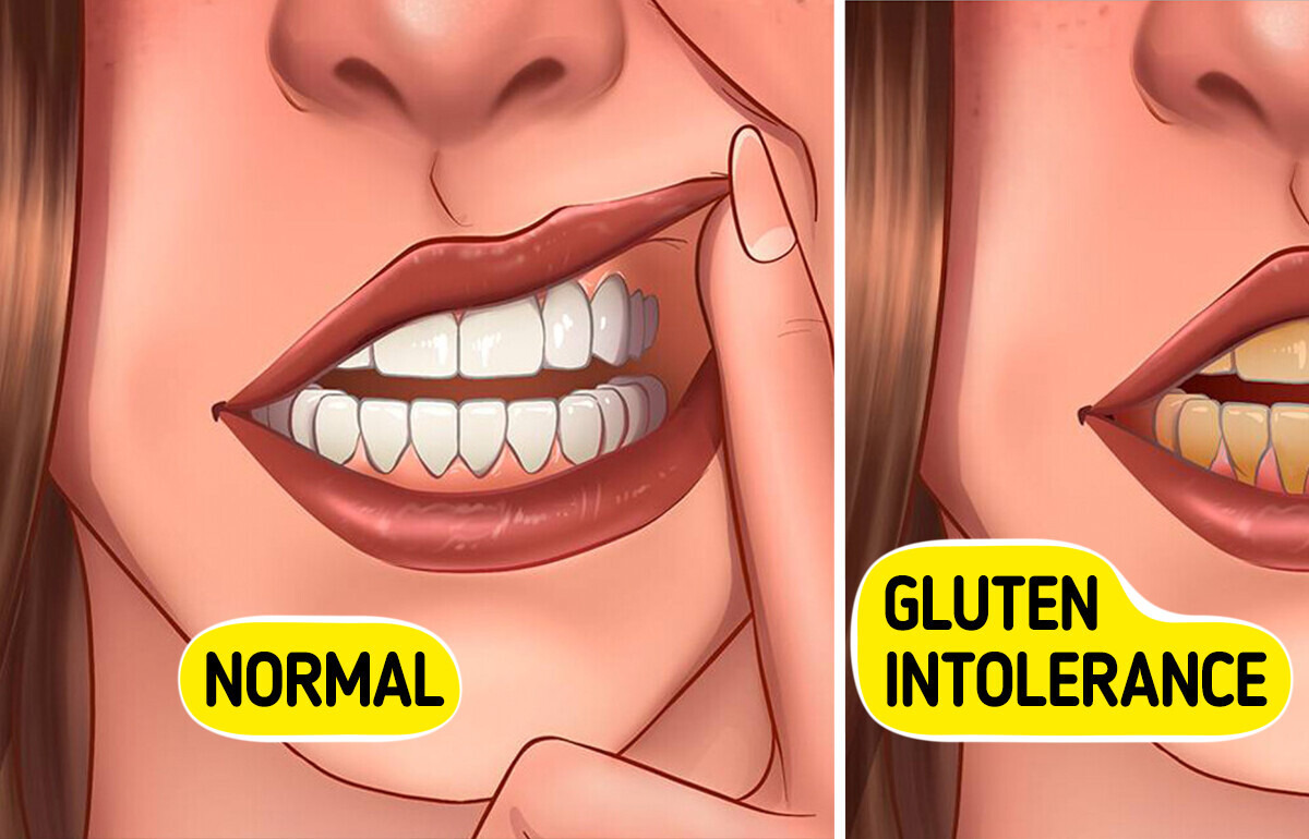 11 Gluten Intolerance Signs People Tend to Overlook