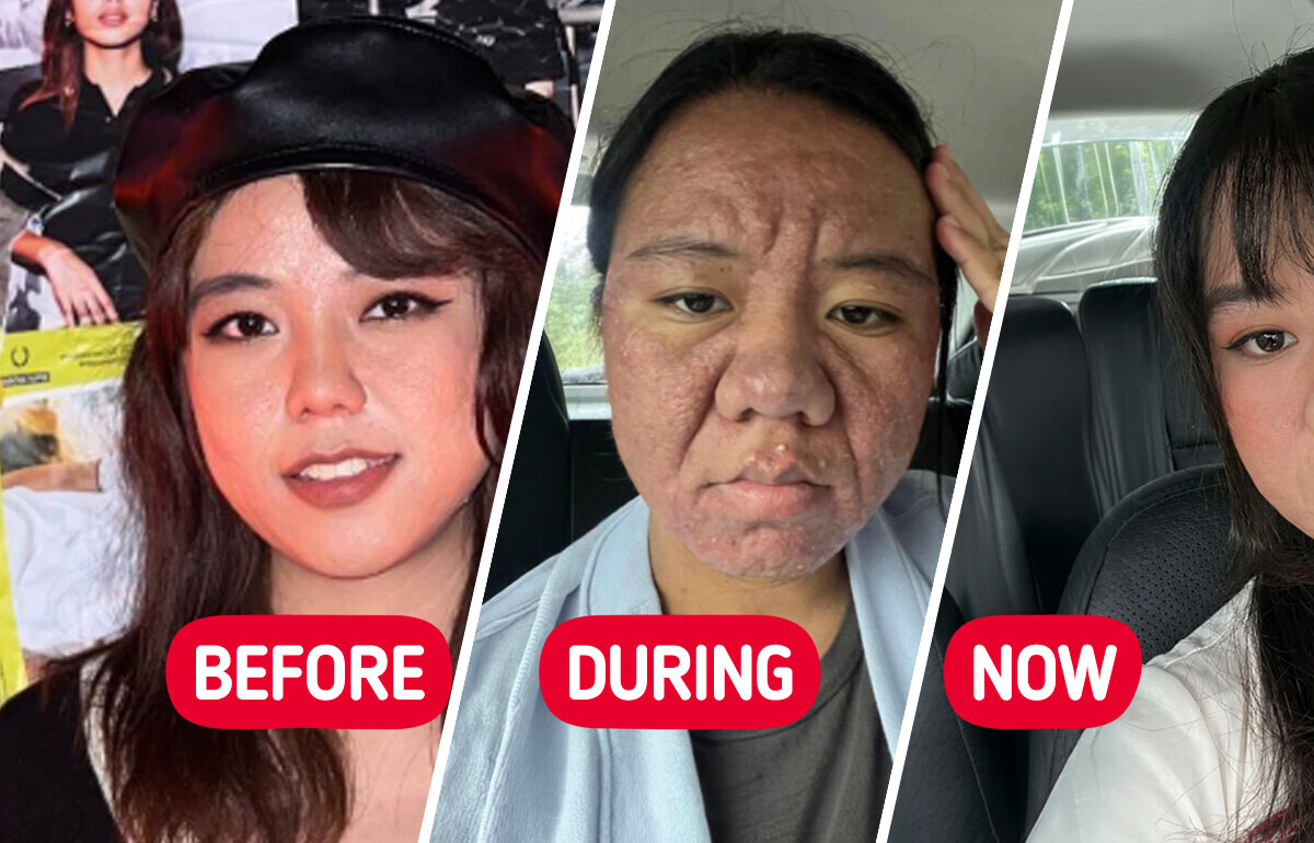 “Are You Allergic to Your Baby?” Woman Shares How Pregnancy Changed Her Face That Proves the Power of Self-Love and Compassion