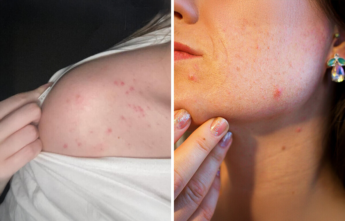 Why Acne Appears on These 8 Body Areas, and What You Should Do