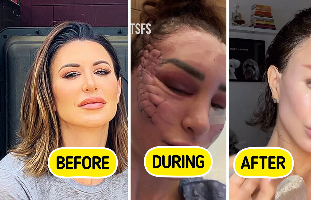 Woman Transforms Her Face Through “Unusual” Facelift, Sparks Debate Woman Transforms Her Face Through “Unusual” Facelift, Sparks Debate