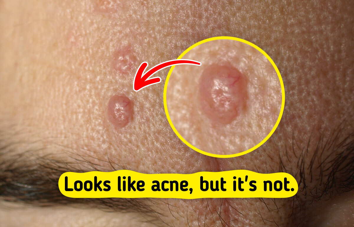 7 Skin Bumps You Might Mistake for Acne 7 Skin Bumps You Might Mistake for Acne