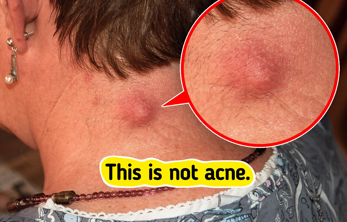 7 Skin Bumps That Aren’t Acne You Might Be Overlooking 7 Skin Bumps That Aren’t Acne You Might Be Overlooking