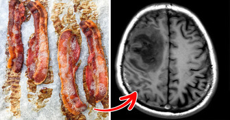 Worm Eggs Discovered in Man’s Brain After Migraine Complaints — Undercooked Bacon Was the Reason