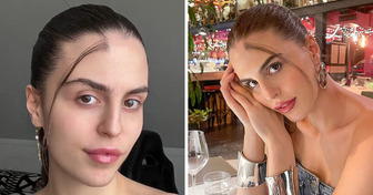 A Woman Was Born With a Lock of Hair in the Middle of Her Forehead and Doesn’t Mind the Hateful Comments
