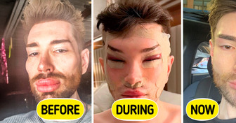 A Man’s Drastic Cat-Eye Surgery and Filler Removal Transformation Shocks Viewers