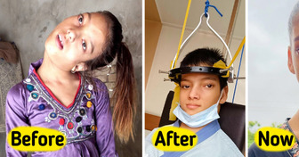 Doctor Treated Girl with 90-Degree Bent Neck for Free After 12 Years of Pain