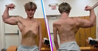 A Boy Reveals a Surprising Reason Why He Has One Arm Much Bigger Than the Other (Not What You Think It Is)