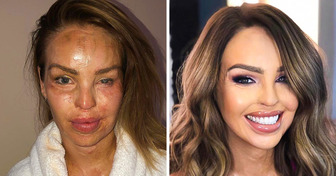 Katie Piper Survived an Acid Attack From Her Ex-Boyfriend and Rose Like a Phoenix From the Ashes