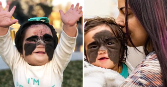 A Little Girl Was Called “Monster” for Her “Batman” Face, Now She Looks Like a Disney Princess