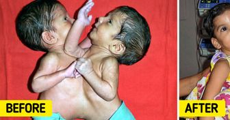 The Story of the Conjoined Twins That Were Separated After 12 Hours in Operation