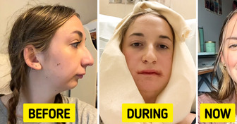 Young Woman Reveals Dramatic Results of Her Jaw Surgery, Leaving People Stunned