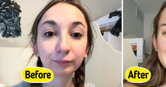Young Woman’s Jaw Surgery Transformation Sparks Massive Reactions