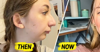 Young Woman Undergoes Complex Jaw Surgery and Stuns the Internet With the Change