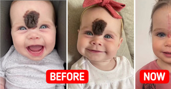’’We Got Stares’’, Parents Choose to Remove Baby Girl’s Rare Birthmark to Avoid Rude Reactions