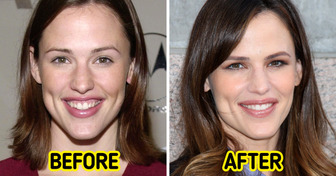 17 Celebrities Who Decided to Change Their Teeth and Started Shining Even Brighter