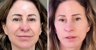 A Woman Sells Her House to Pay for a Face Lift: “Results Are Beyond What I Expected”