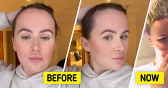 A Woman Decides to Undergo Forehead Reduction Surgery After Being Shamed for It