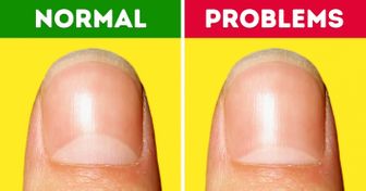 13 Health Problems the Moons on Your Nails Warn You About